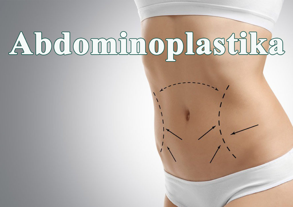 Abdominoplastika