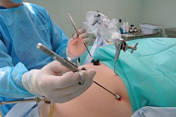 Laparoskopik yolla uşaqlıq borularının bağlanması